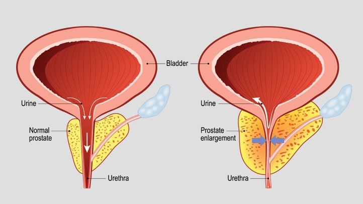 Everything You Should Know About Prostatic Hyperplasia